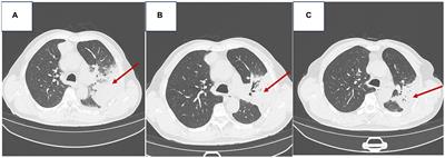 Case report: A patient with HHV-6 and HHV-7 combined with Whipple’s trophoblast infection and streptococcal pneumonia